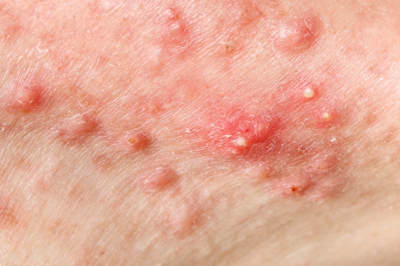 Acne & Spot Care