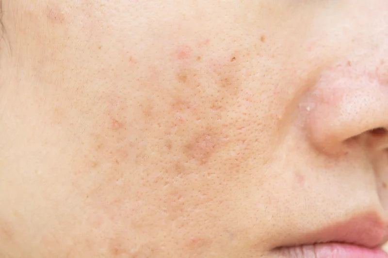 Dark Spots & Uneven Tone